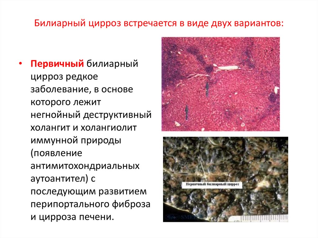 Вторичный билиарный цирроз печени