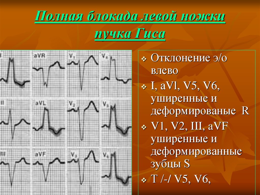 Лечение полная блокада левой ножки