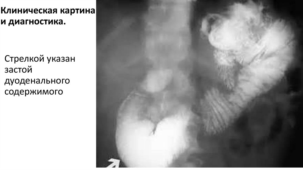 Клиническая картина и диагностика.