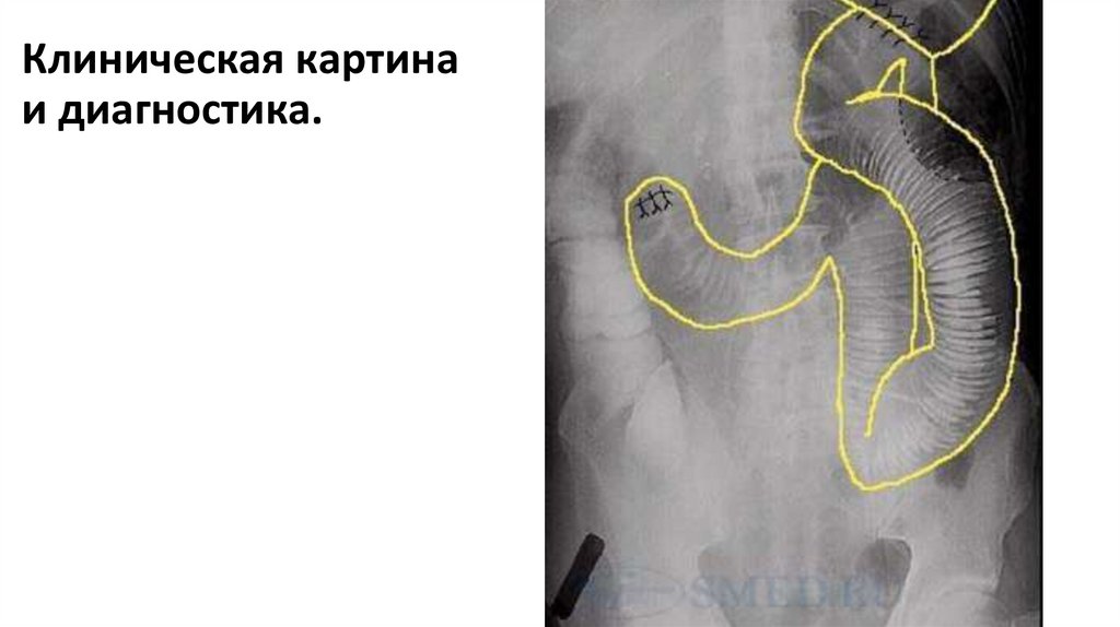 Клиническая картина и диагностика.