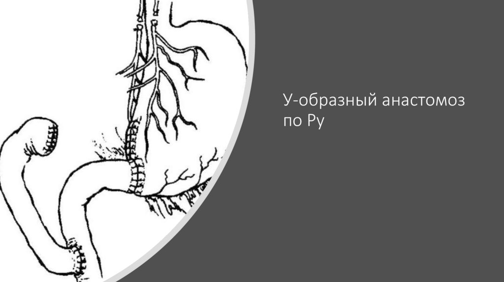 У-образный анастомоз по Ру
