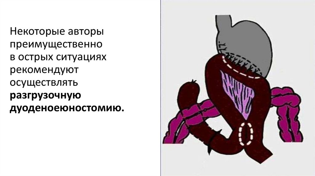 Некоторые авторы преимущественно в острых ситуациях  рекомендуют осуществлять  разгрузочную  дуоденоеюностомию.