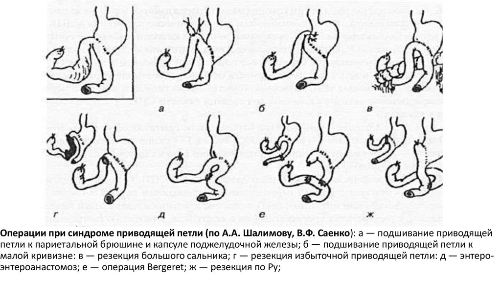 Операции при синдроме приводящей петли (по А.А. Шалимову, В.Ф. Саенко): а — подшивание приводящей петли к париетальной брюшине