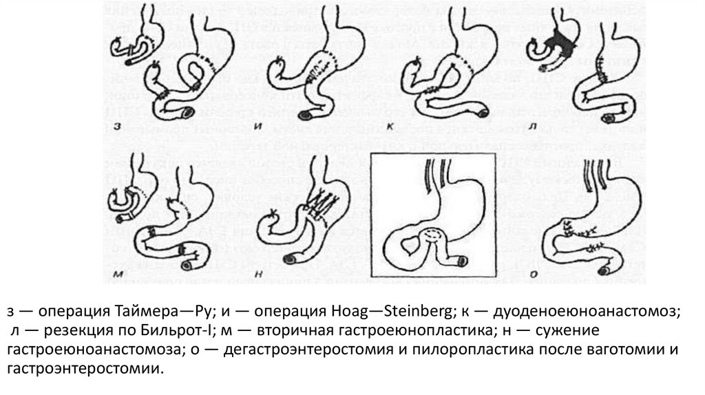 з — операция Таймера—Ру; и — операция Hoag—Steinberg; к — дуоденоеюноанастомоз;  л — резекция по Бильрот-I; м — вторичная