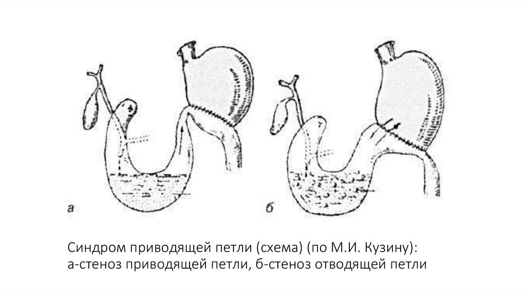 Синдром приводящей петли (схема) (по М.И. Кузину): а-стеноз приводящей петли, б-стеноз отводящей петли