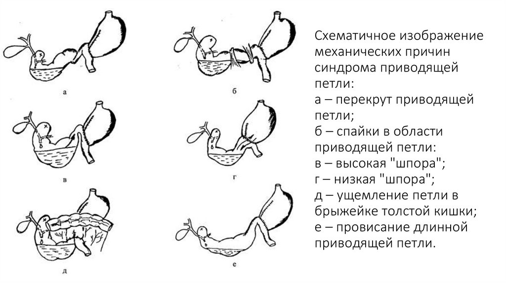 Схематичное изображение механических причин синдрома приводящей петли: а – перекрут приводящей петли; б – спайки в области