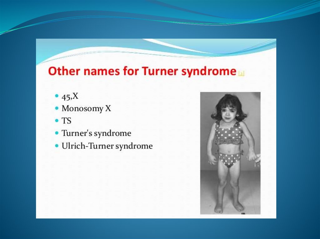 Turner Syndrome Online Presentation 