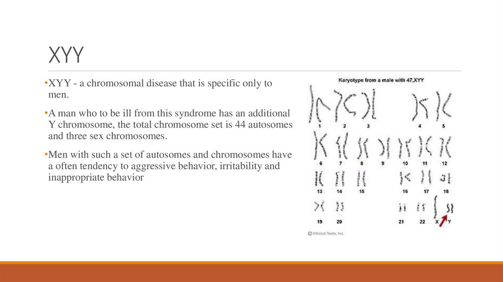 Xyy Syndrome Online Presentation