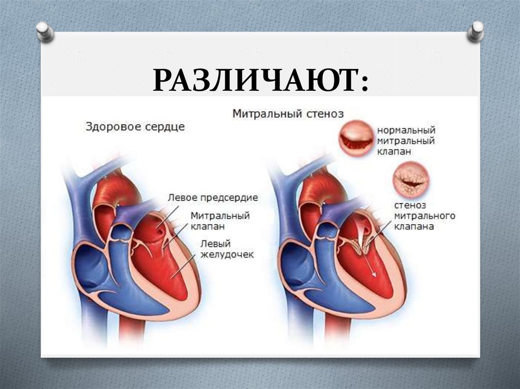 Сердечный стеноз. Комбинированный ревматический порок митрального клапана. Стеноз митрального клапана клинические проявления. Пороки митрального клапана стеноз. Приобретенный ревматический порок сердца.