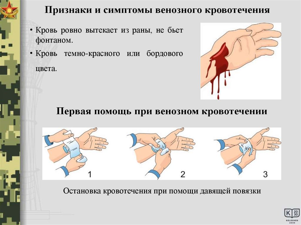 Вид кровотечения первая помощь таблица 9 класс