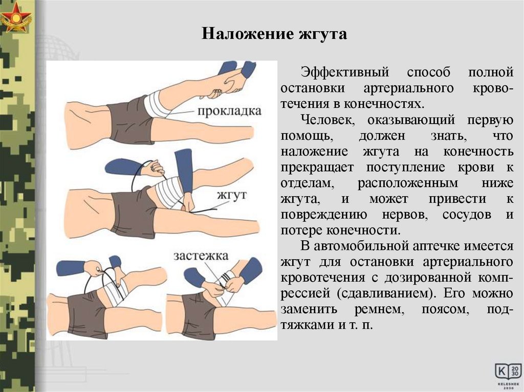 Что сделать после наложения жгута