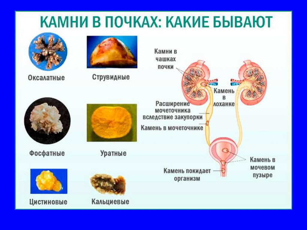 Выходит камень симптомы у мужчин