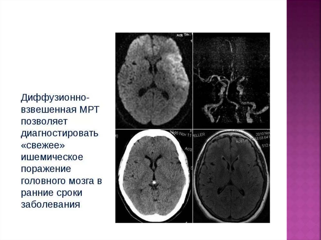 Инсульт на мрт головного мозга картинки