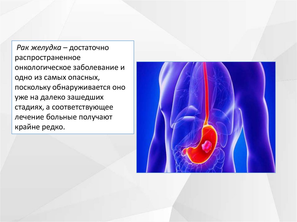 Онкология желудка 4 стадия. Онкологические заболевания желудка. Что такое рак:онкология презентация. Карцинома презентация.