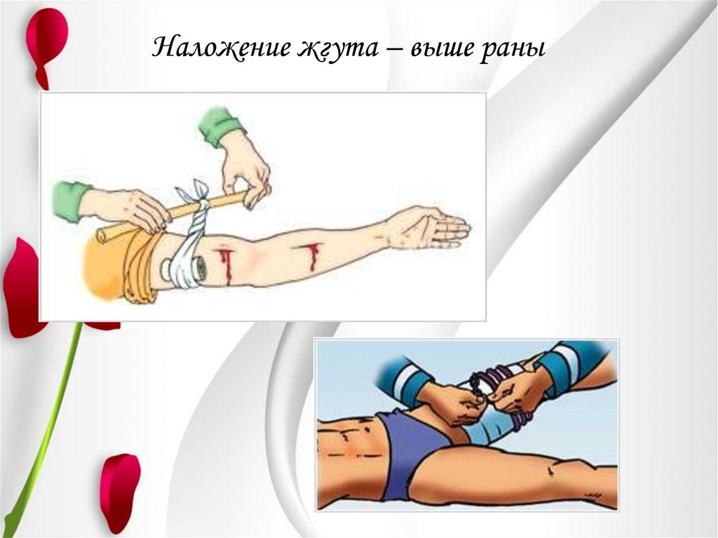Наложение жгута – выше раны