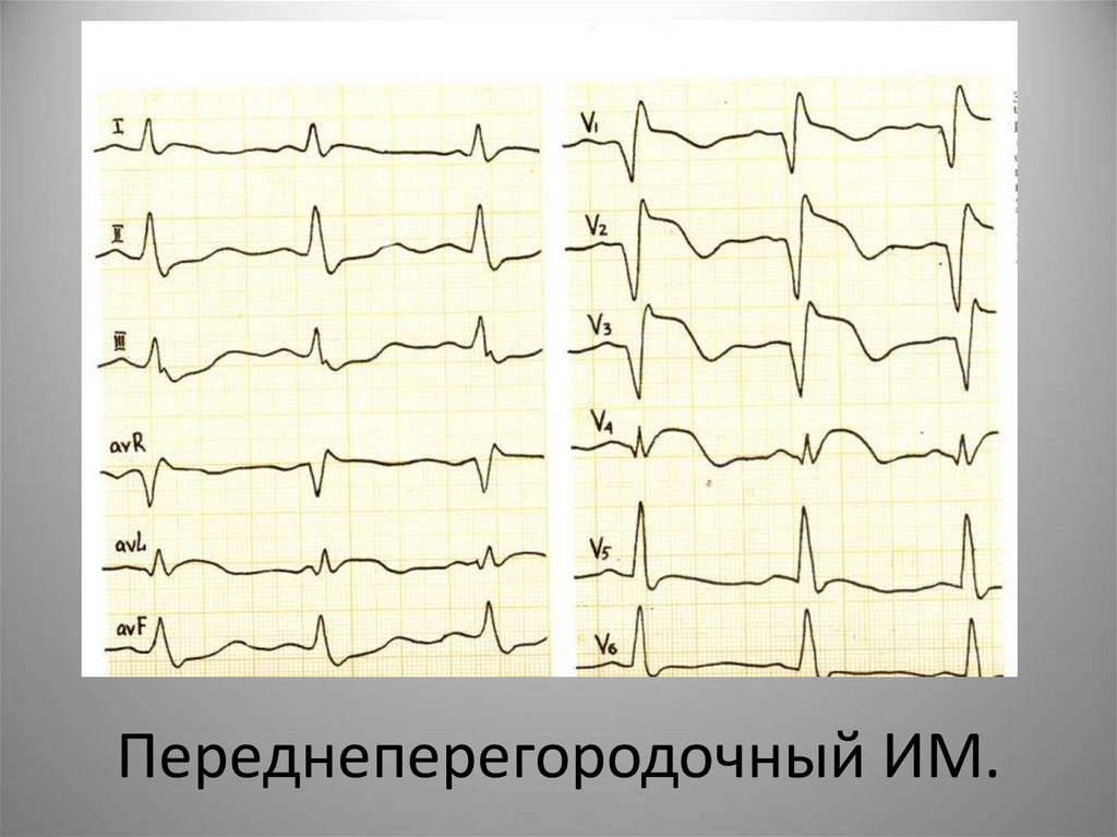 Переднеперегородочный ИМ.