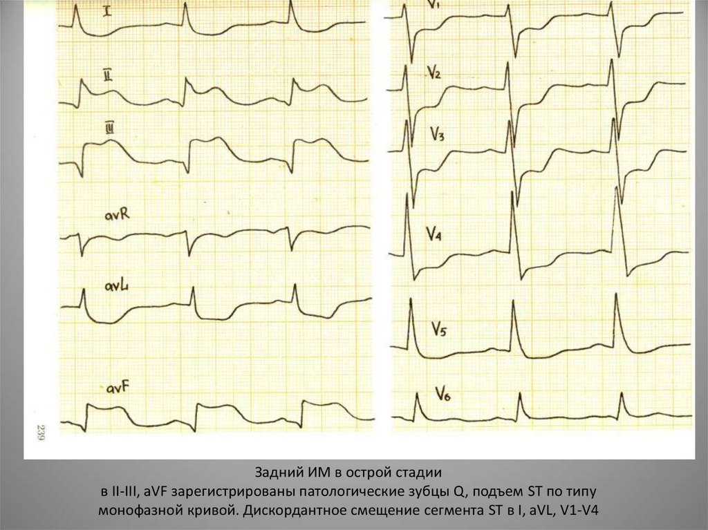 Задний ИМ в острой стадии в II-III, aVF зарегистрированы патологические зубцы Q, подъем ST по типу монофазной кривой.