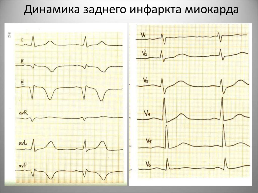 Динамика заднего инфаркта миокарда