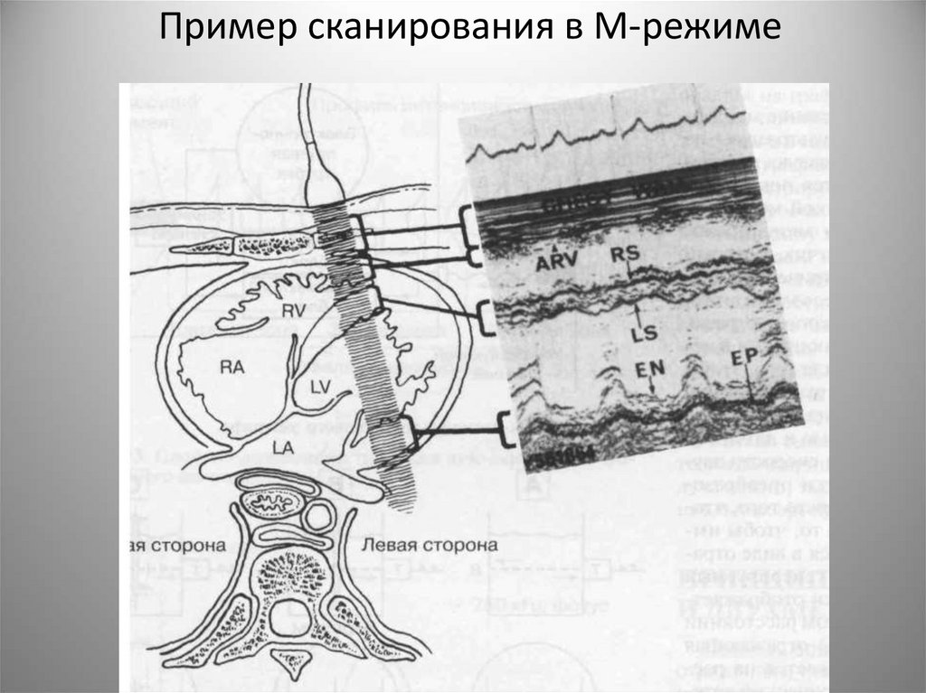 Пример сканирования в М-режиме