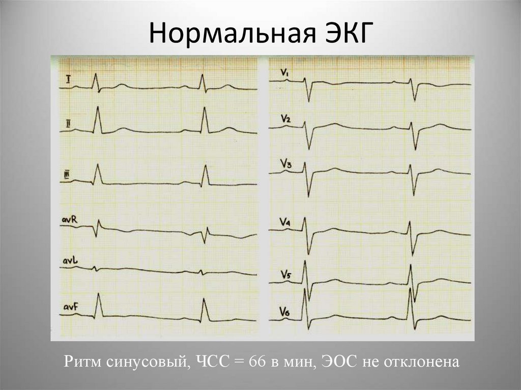 Нормальная ЭКГ
