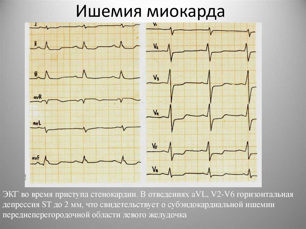 Ишемия сердца на экг фото