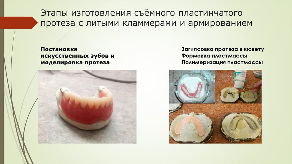 Пластиночный протез этапы. Этапы изготовления частичного съемного пластиночного протеза. Армирование съемного протеза. Пластиночный протез с армированием. Этапы изготовления частично съёмного протеза.