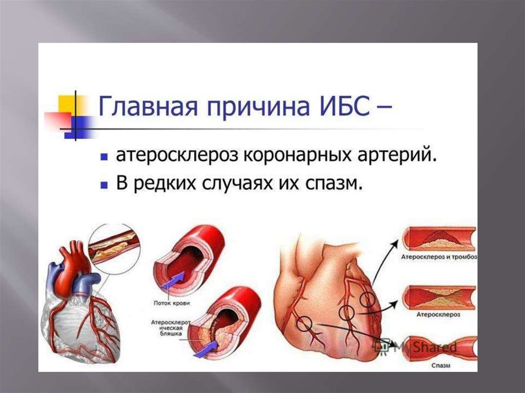Атеросклероз ишемическая болезнь сердца презентация - 95 фото