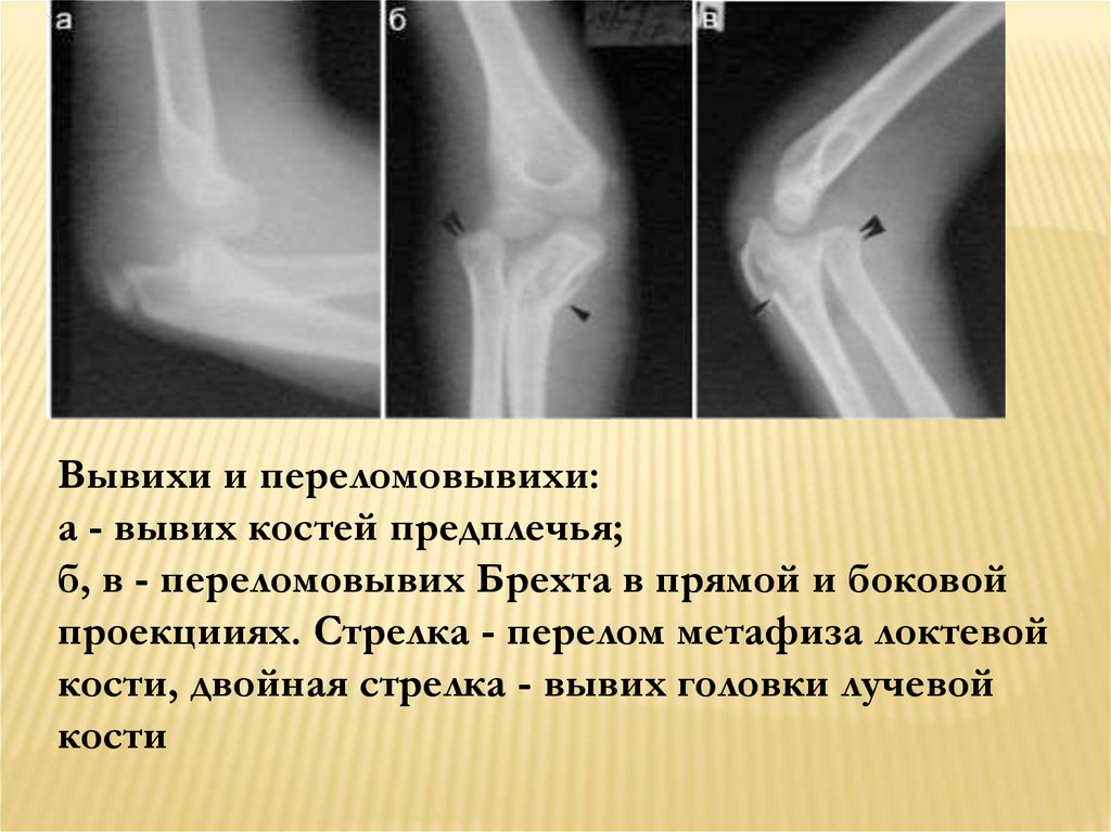 Вывих локтевой кости