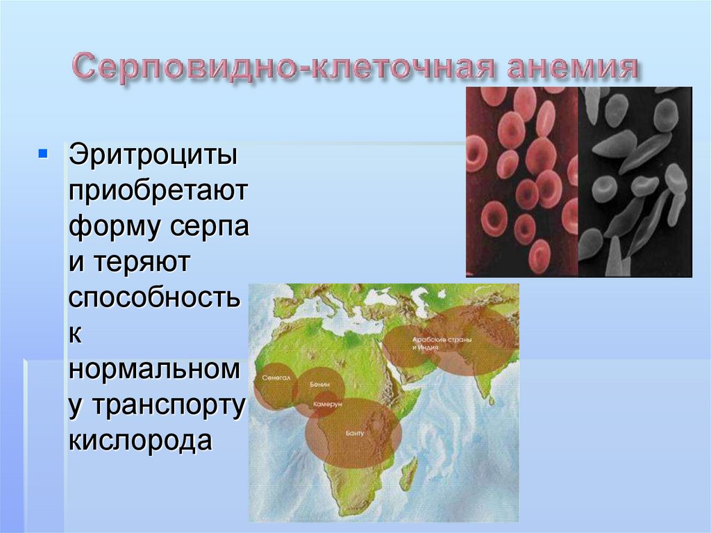 Эритроциты при серповидно клеточной анемии. Серповидноклеточная анемия эритроциты. Эритроциты серповидной формы. Серповидноклеточная анемия генетика. Наследование серповидноклеточной анемии.