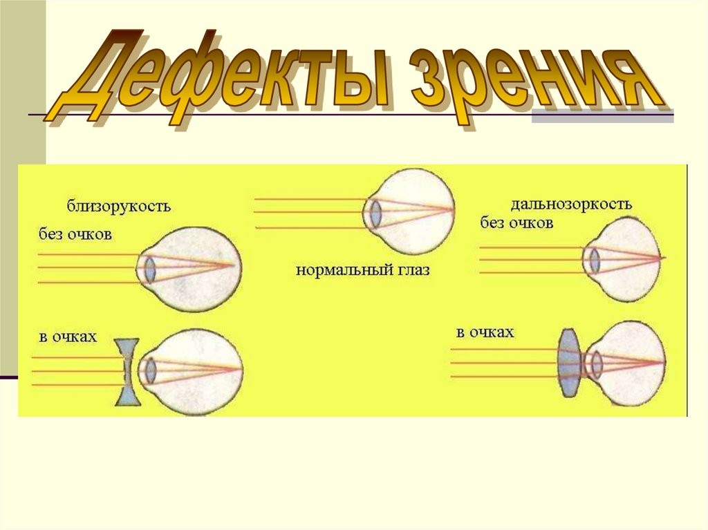 Близорукость и дальнозоркость физика 8 класс презентация