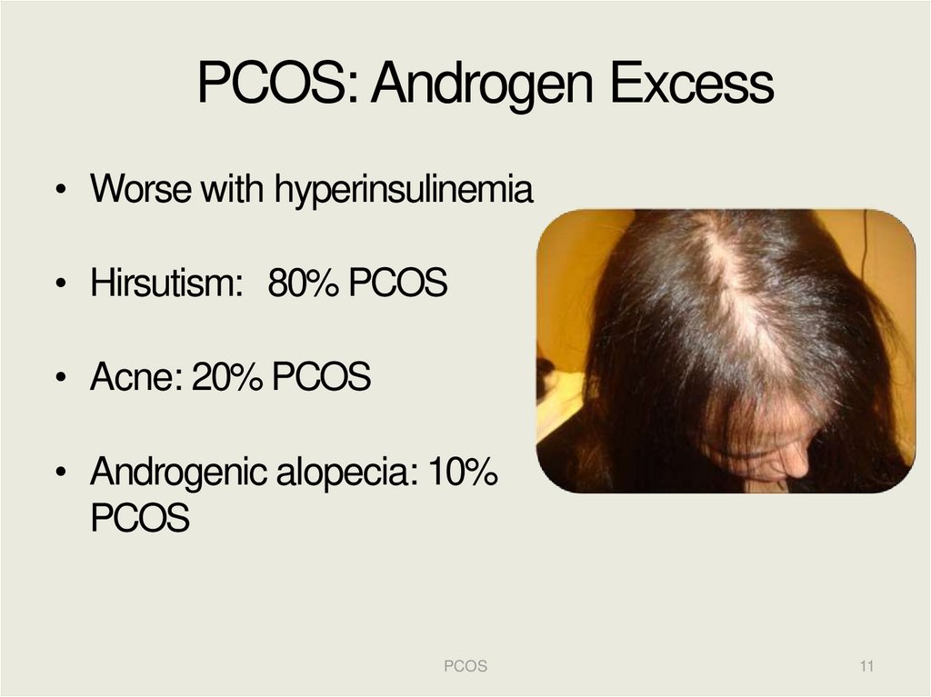 Hirsutism pcos without Does PCOS
