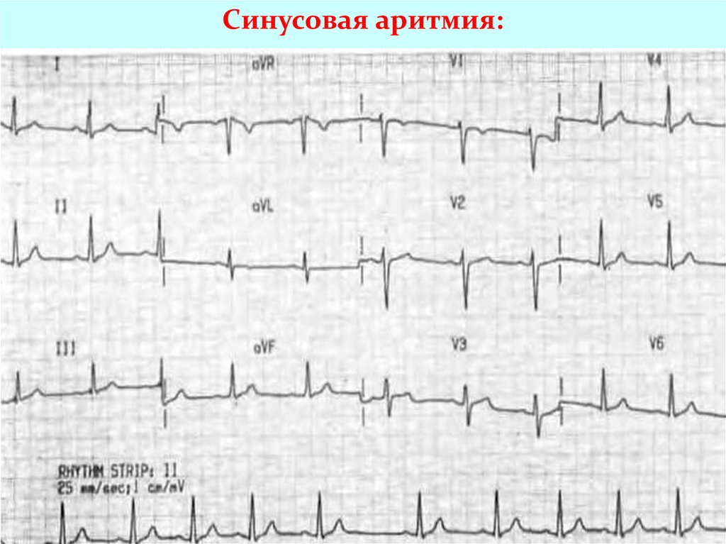 Нарушение ритма 7. Arrhythmia.