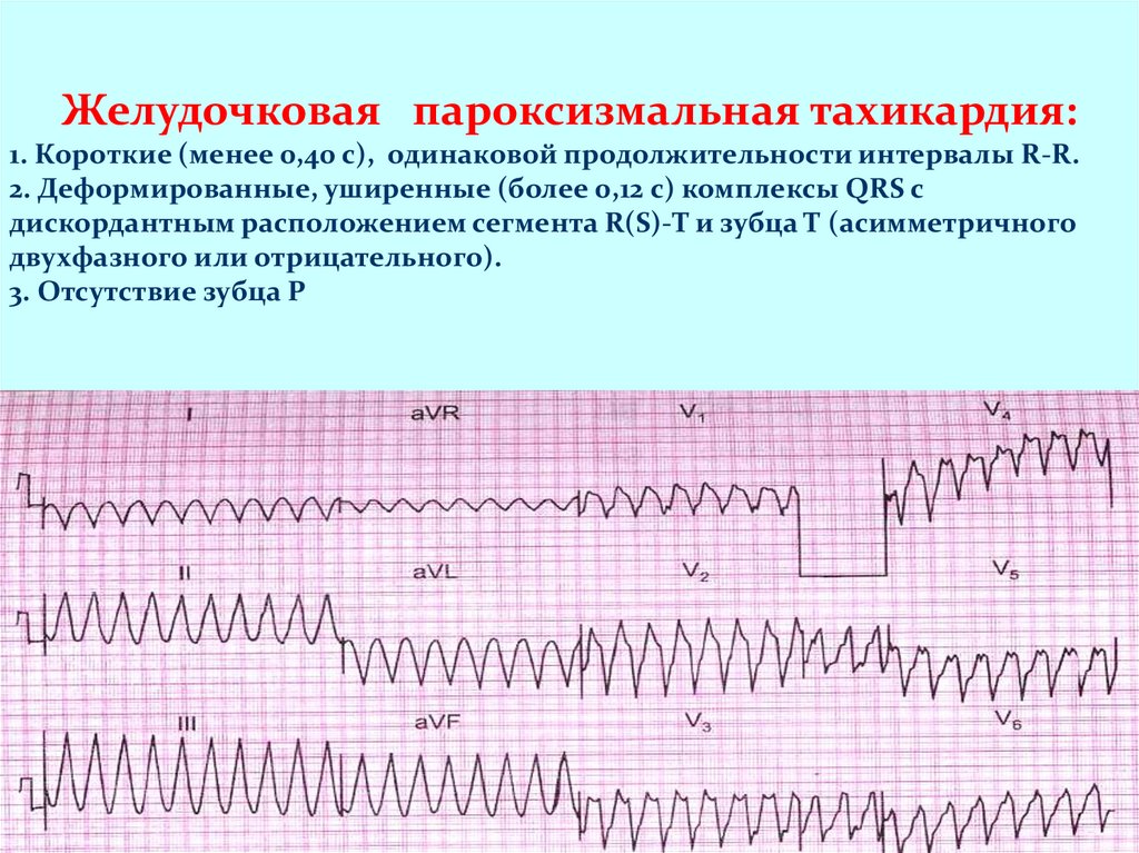 Желудочковое нарушение. Пароксизмальная желудочковая тахикардия на ЭКГ. Пароксизмальная тахикардия изменения на ЭКГ. ЭКГ при нарушениях ритма и проводимости. Пароксизмальная желудочковая тахикардия клиника.