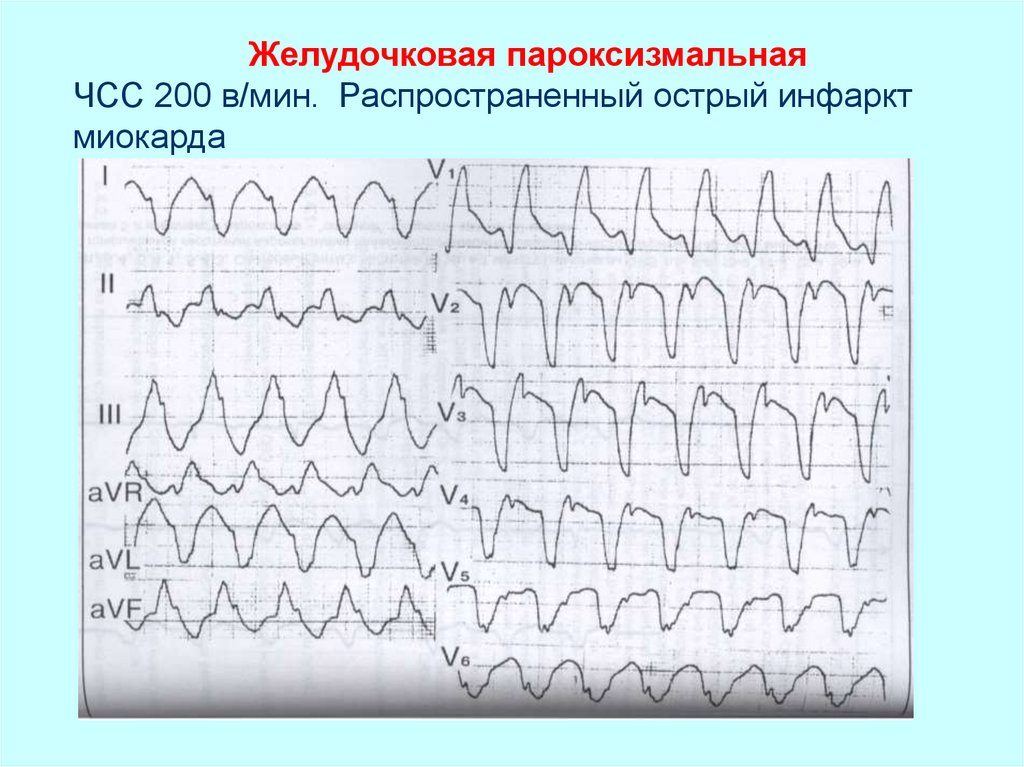 Желудочковый ритм. Желудочковая тахикардия атлас ЭКГ. Желудочковая тахикардия с ЧСС 150. Тахикардия при инфаркте миокарда ЭКГ. Пароксизмальная мономорфная желудочковая тахикардия.