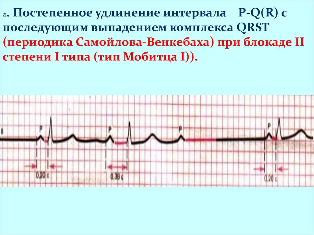 Выпадение комплекса. АВ блокада 2 степени Мобитц 1 с периодикой Самойлова Венкебаха. Периодика Самойлова Венкебаха на ЭКГ. Синоатриальная блокада 2 ст Мобитц 1. ЭКГ блокада Самойлова-Венкебаха.