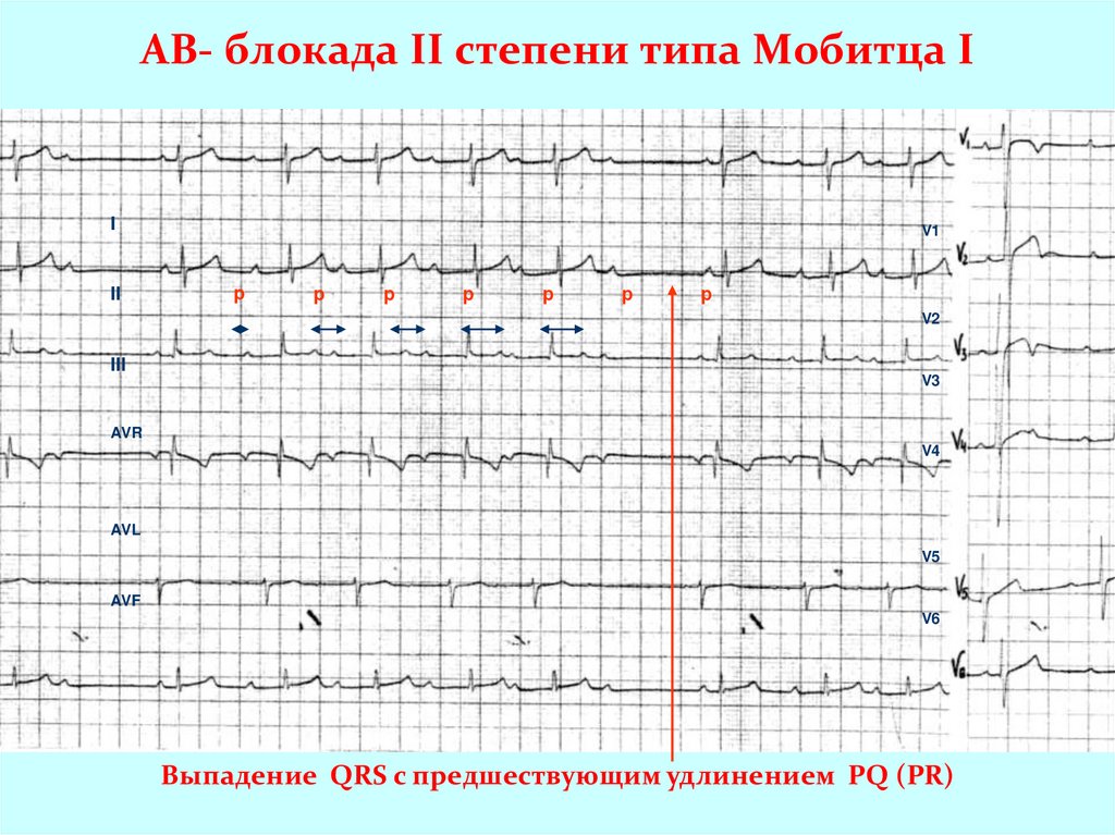 Экг ав. АВ блокада 1 2 3 степени на ЭКГ. АВ блокада 2 степени 1 типа 3:1. Проксимальный Тип АВ блокады ЭКГ. АВ блокада Мобитц 3.