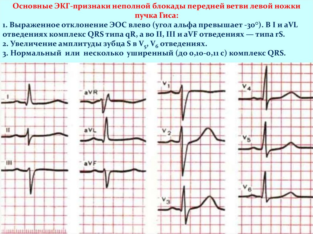 Неполная блокада ножки гиса на экг. Блокада левой ножки пучка Гиса на ЭКГ ЭОС. ЭКГ при неполной блокаде ножек пучка Гиса.. Блокада левой ножки п Гиса на ЭКГ. ЭКГ при неполной блокаде правой ножки.