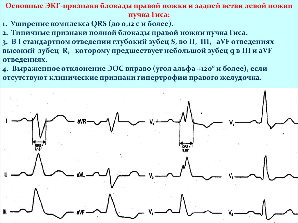 Блокады на экг. ЭКГ при блокаде левой задней ветви пучка Гиса. Блокада задней ножки пучка Гиса на ЭКГ. Полная блокада ЛНПГ на ЭКГ. Блокада левой ножки пучка Гиса (нарушение проводимости) ЭКГ.