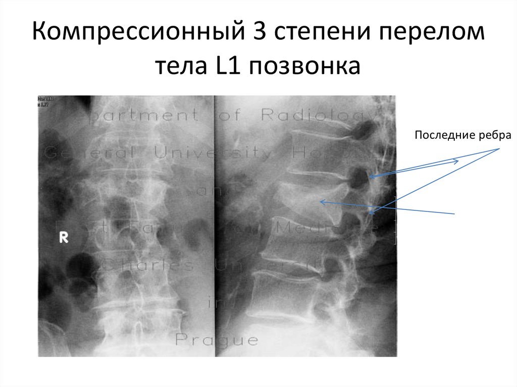 Компрессионно оскольчатый перелом