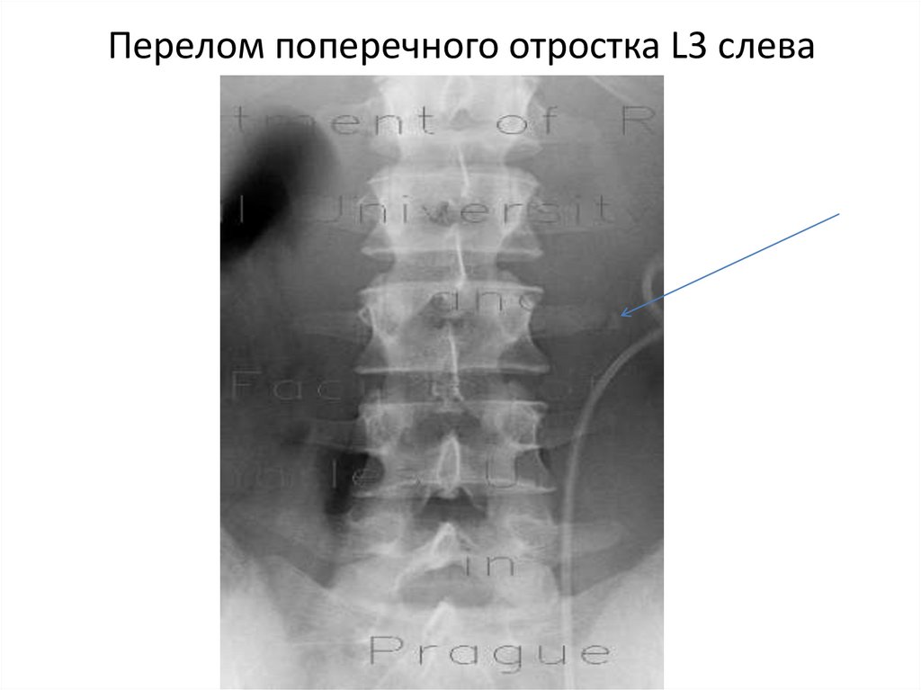 Остистый отросток фото