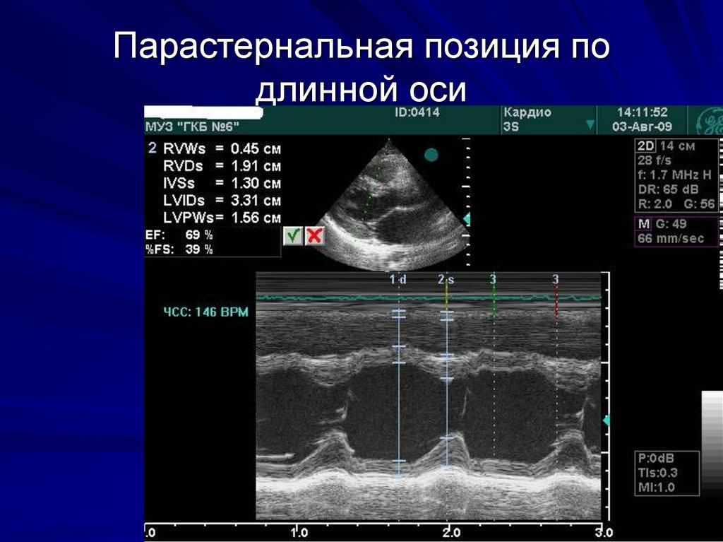 Эхо левого желудочка. Парастернальная позиция по короткой оси аортального клапана. УЗИ сердца парастернальная позиция. Доступы при ультразвуковом исследовании сердца. Эхо-кг парастернальная позиция.