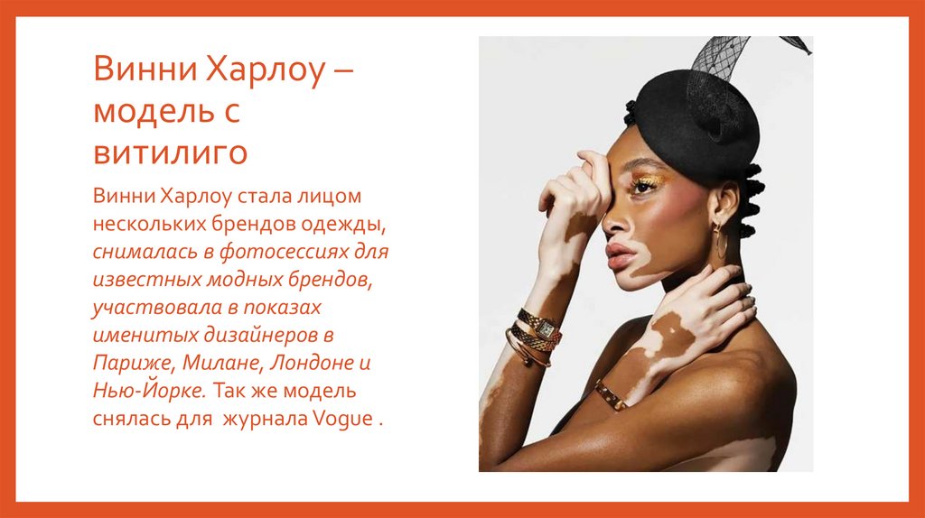 Винни Харлоу – модель с витилиго