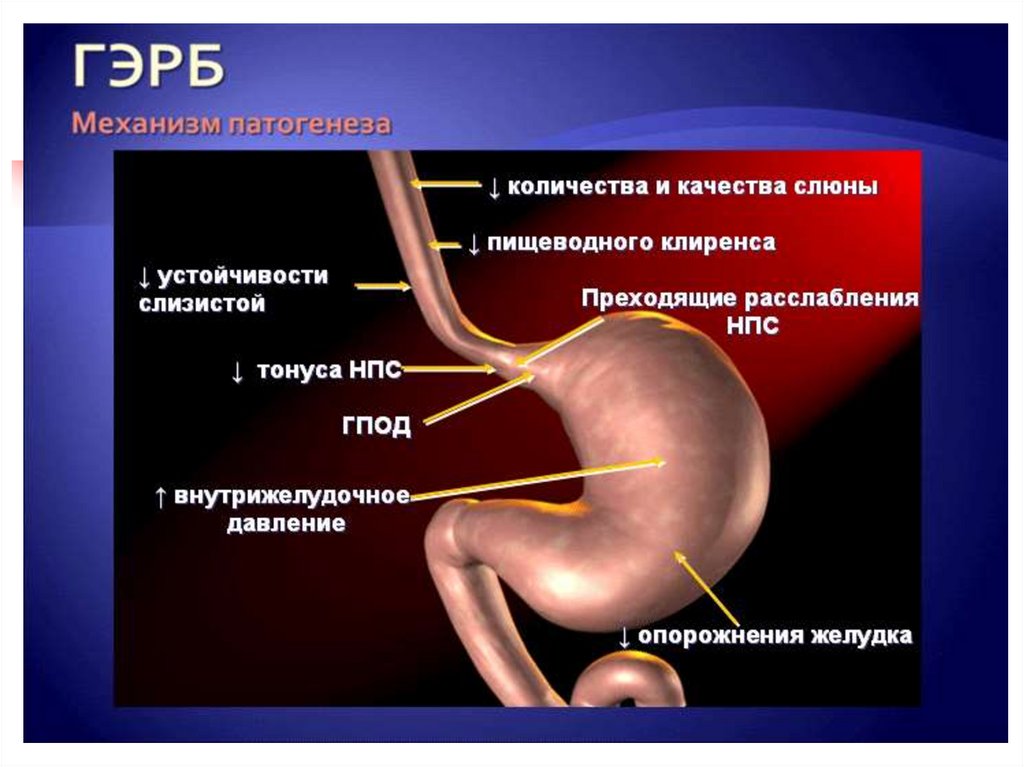 Рефлюксная болезнь презентация