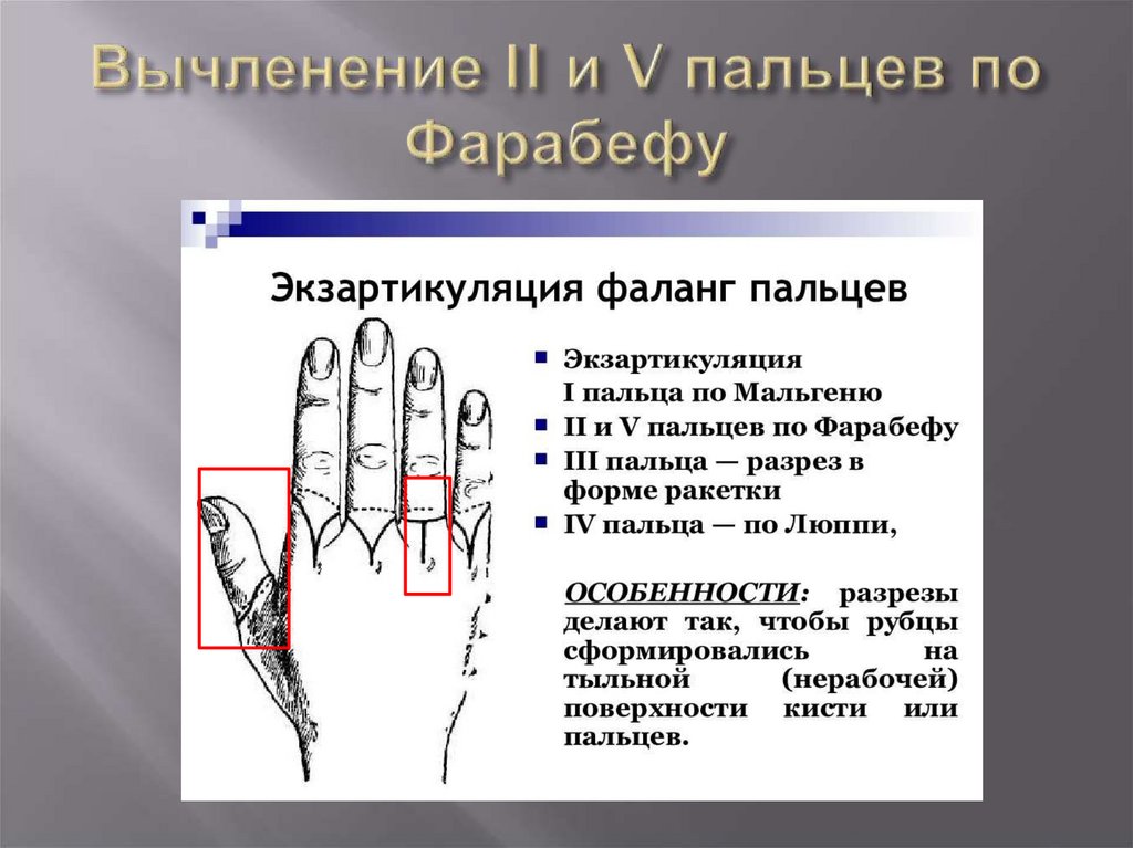Ампутация пальцев мкб 10. Фаланга пальца. Фаланги пальцев кисти. Первая фаланга среднего пальца.