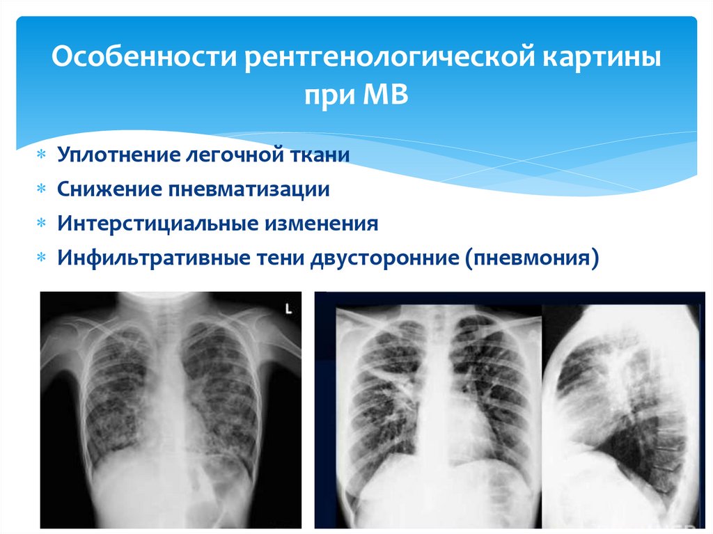 Муковисцидоз рентгенологическая картина