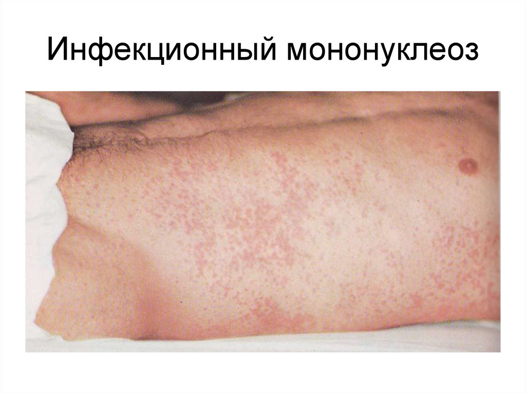 Инфекционный мононуклеоз
