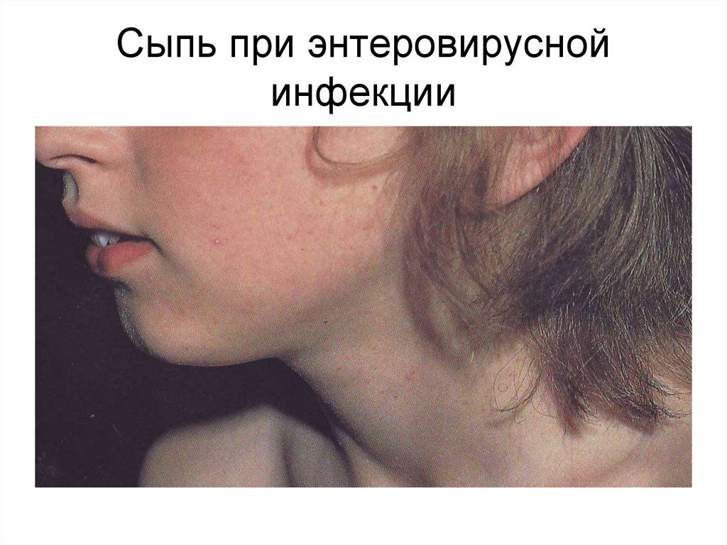 Сыпь при энтеровирусной инфекции