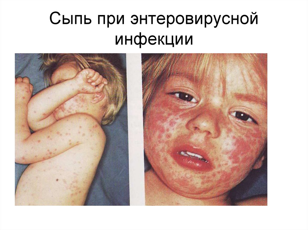 Сыпь при энтеровирусной инфекции
