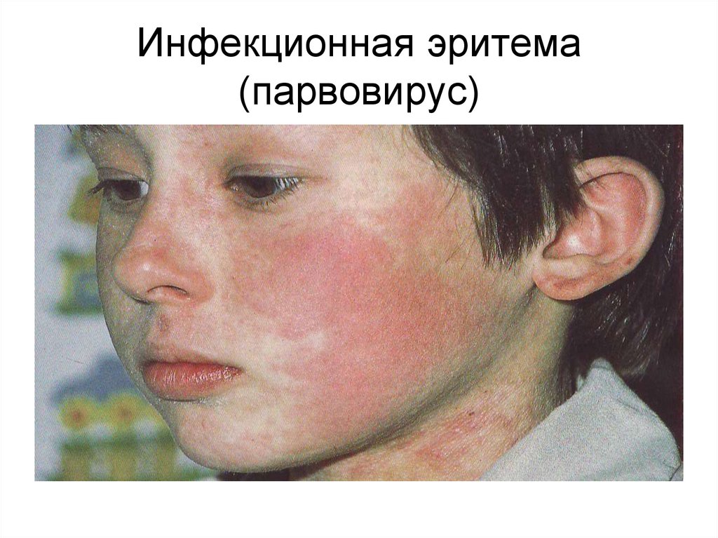 Инфекционная эритема (парвовирус)
