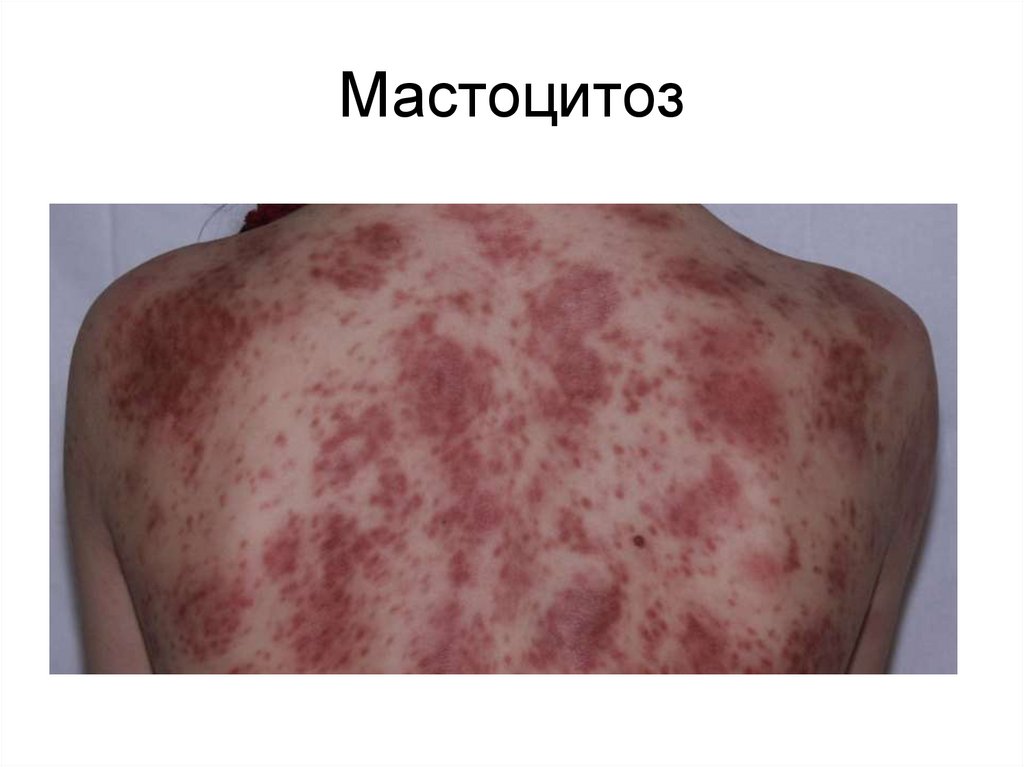 Мастоцитоз